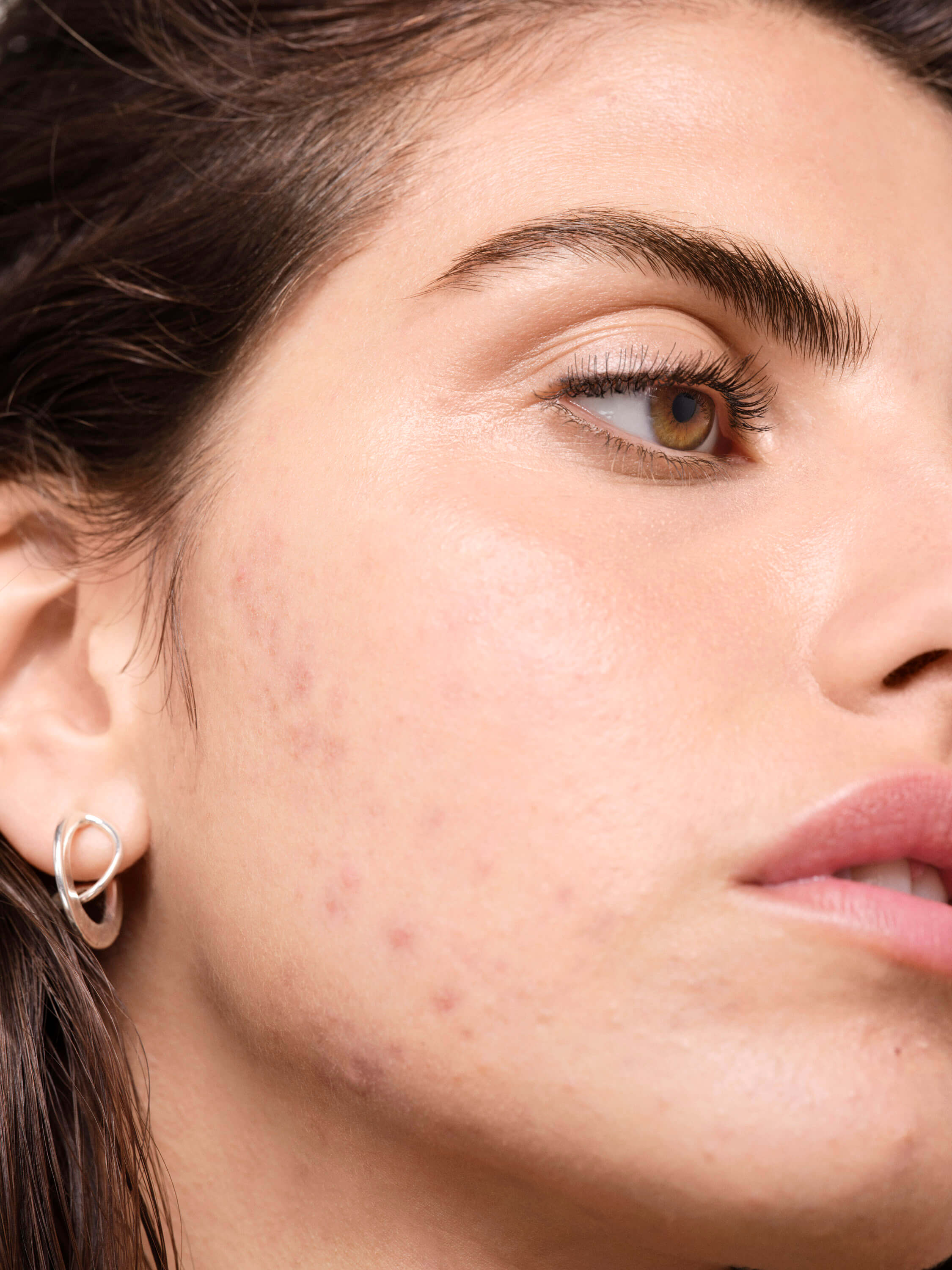 ACNE | CONHEÇA AS RECOMENDAÇÕES DE ESPECIALISTAS SOBRE ACNE