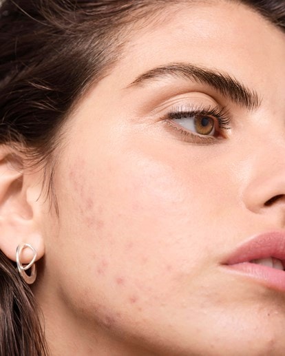 ACNE | CONHEÇA AS RECOMENDAÇÕES DE ESPECIALISTAS SOBRE ACNE