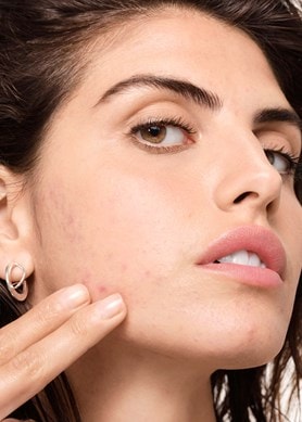 o-que-e-a-acne-hormonal-e-como-uma-rotina-de-cuidados-pode-ajudar